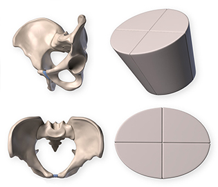 Bucket simplification for the pelvis