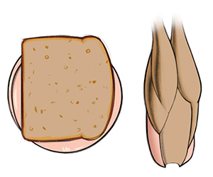 medial head spills out like bologna sandwich