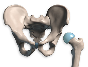 Femur head placement