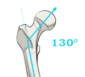 Femur neck angle 130 degrees