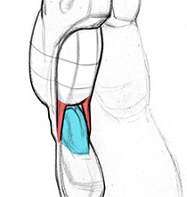 The hamstring tendons as fangs that hold the "egg"